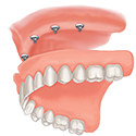 Secure Loose Upper Dentures