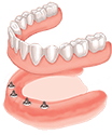 Secure Loose Lower Dentures